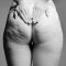 Lichaamsbehandeling - Cellulite